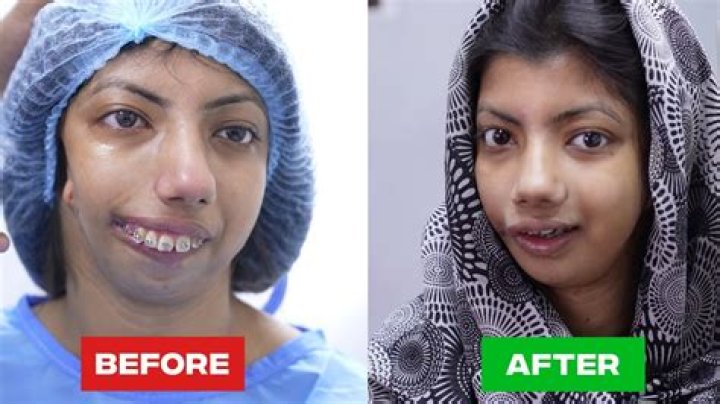 Hazel E Before Surgery: Uncovering Secrets And Transformations