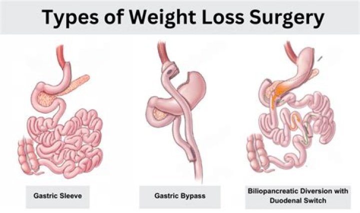 Unlocking The Secrets Of Weight Loss Surgery